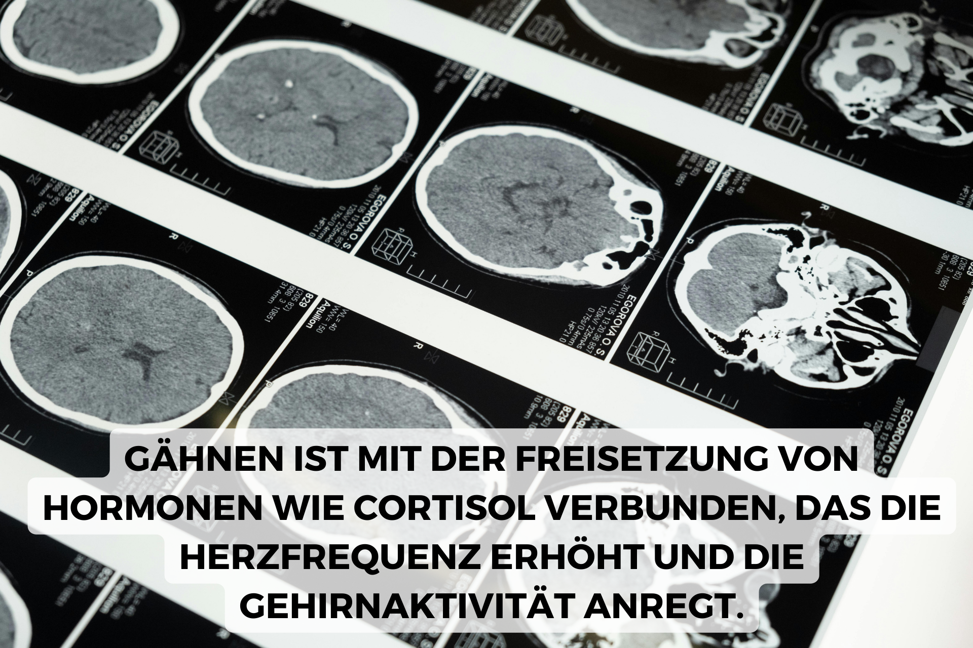 gaehnen ist mit kortisol verlinkt